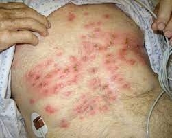 Покупався у ставку та підчепив небезпечну недугу – лептоспіроз