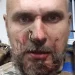 Олег Сенцов отримав поранення на фронті