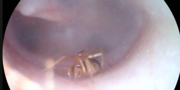 На Тернопільщині у вусі дитини знайшли… павука