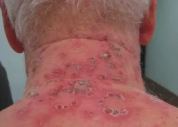 Бульозна короста. Ілюстрація