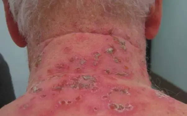 Бульозна короста. Ілюстрація