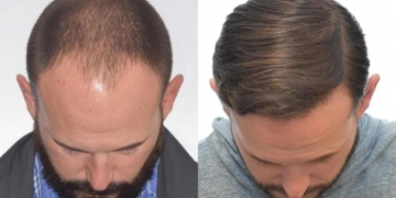 Новий метод лікування алопеції