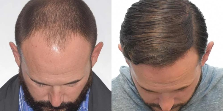 Новий метод лікування алопеції