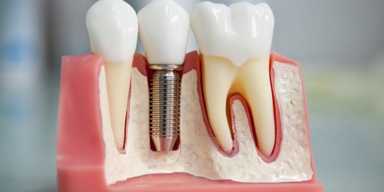 Хто з тернополян має право на безкоштовне зубопротезування